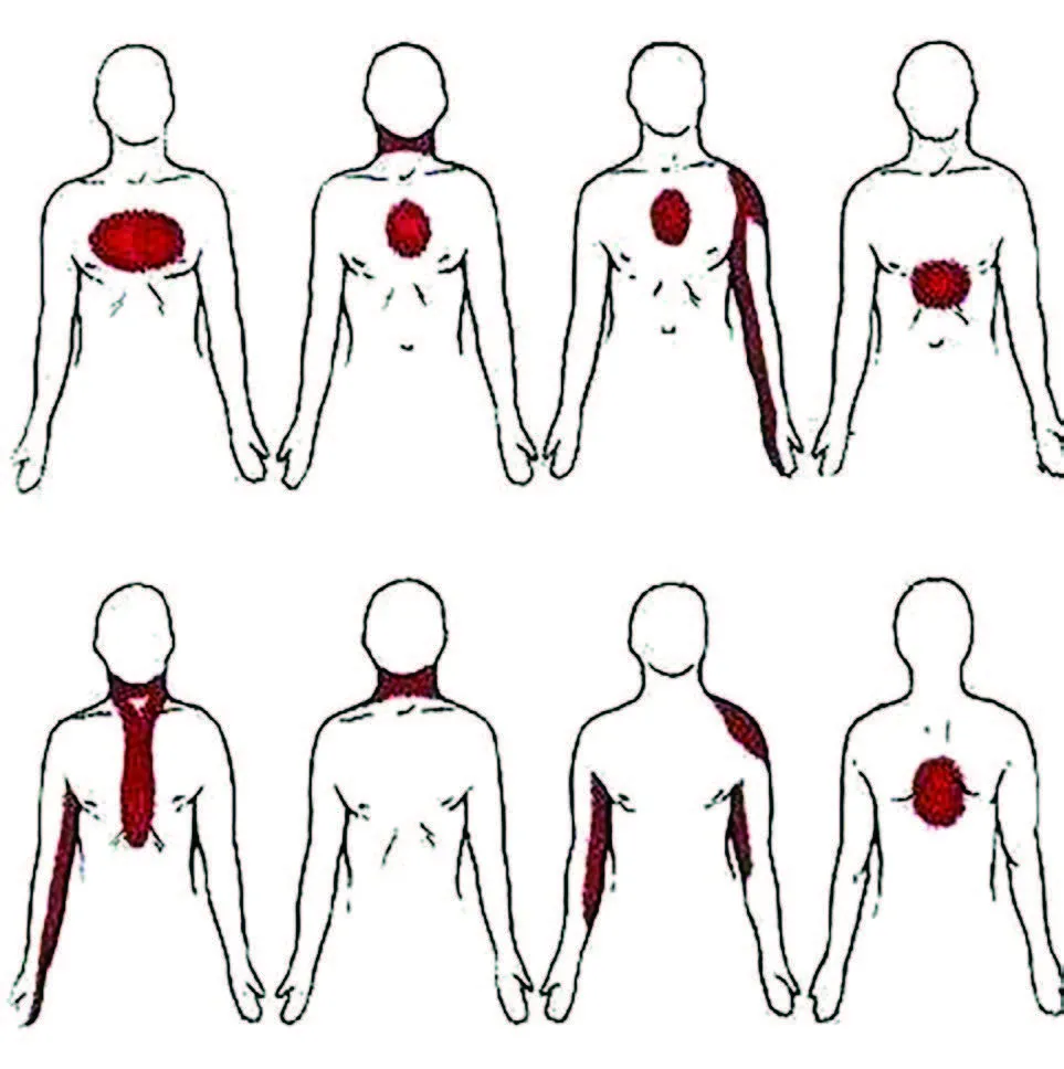 Illustration of chest pain radiating to the arm, neck and jaw — warning signs of a heart attack
