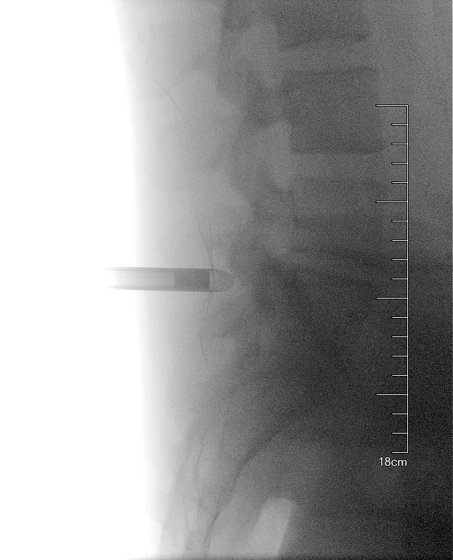 DSA angiography at Jiahui International Hospital