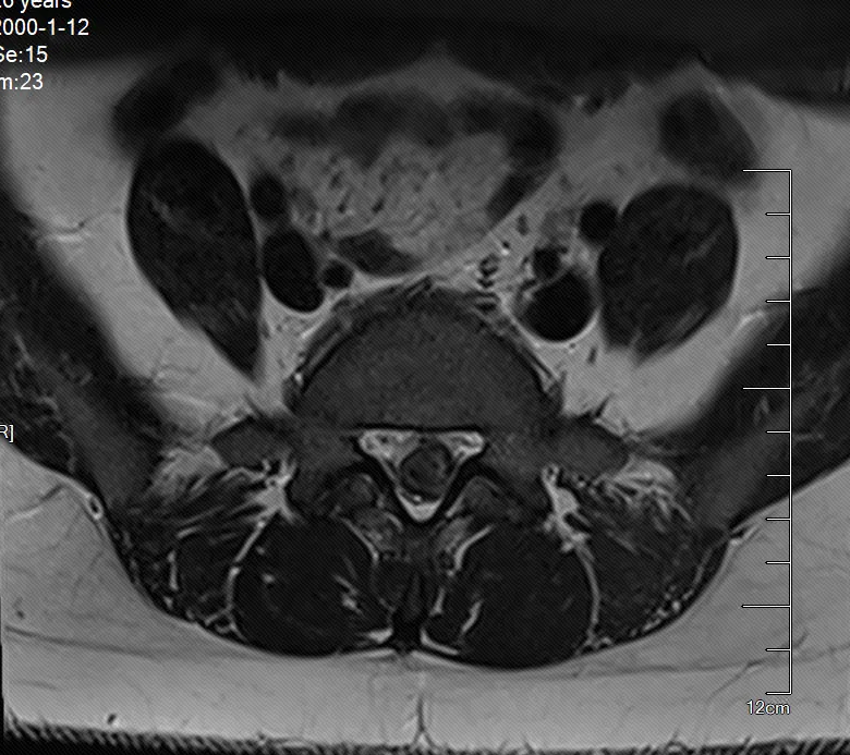 Pre-operative MRI showing massive L5-S1 lumbar disc herniation compressing nerve root