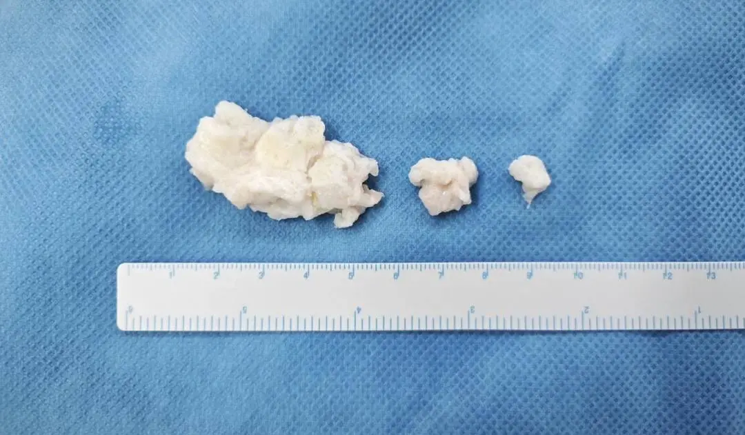 Removed herniated disc tissue and endplate specimens from the PEID procedure